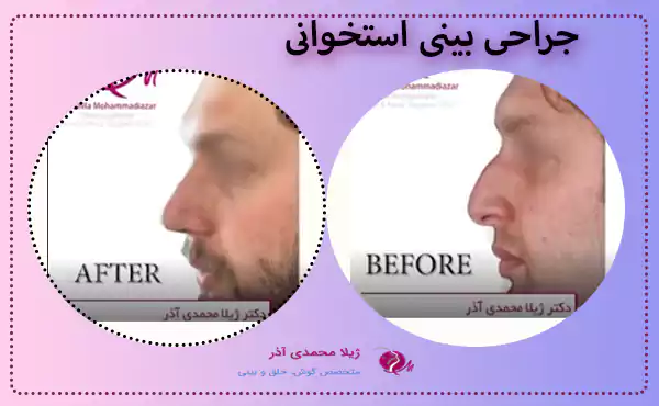 جراحی بینی استخوانی