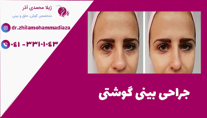 جراحی بینی گوشتی