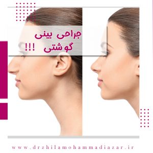 جراح بینی گوشتی