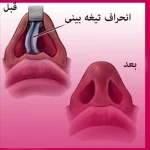 عمل جراحی انحراف بینی - دکترژیلا محمدی آذر