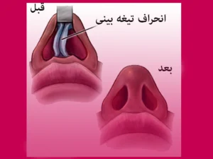 عمل جراحی انحراف بینی - دکترژیلا محمدی آذر