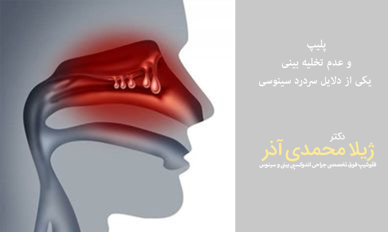 پلیپ یکی از دلایل سردرد سینوسی