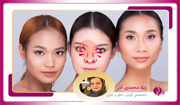 جراحی بینی گوشتی