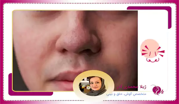 تاثیر جنس پوست بر جراحی بینی گوشتی