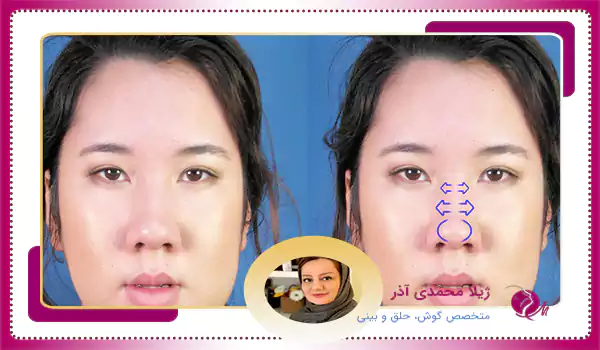 چالش‌های جراحی بینی گوشتی
