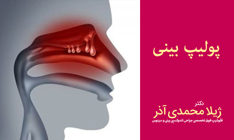 پولیپ بینی - دکتر ژیلا محمدی آذر- تبریز