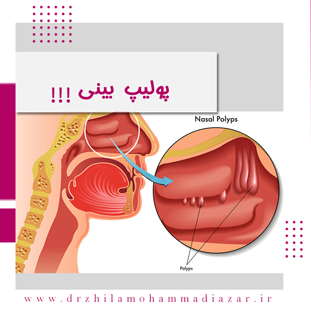 عکس پولیپ بینی