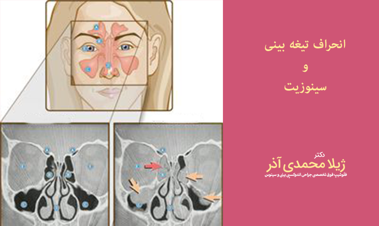انحراف بینی و ارتباط آن با سینوزیت