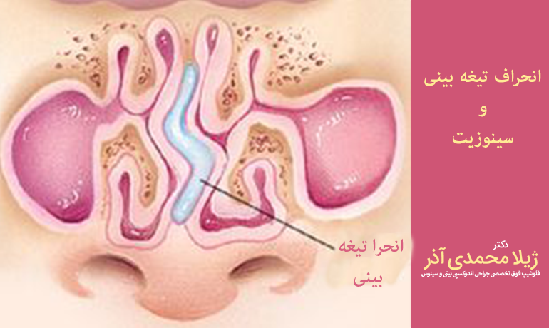 احراف تیغه بینی و سینوزیت