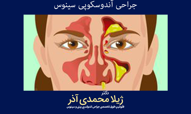 جراحی آندوسکوپی سینوس