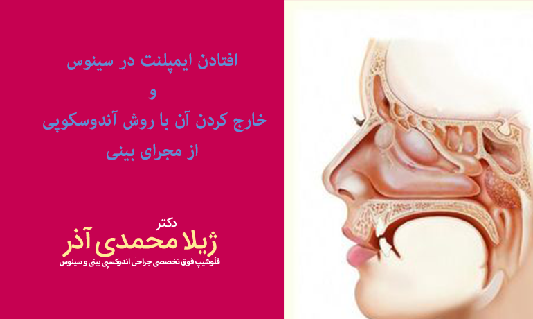 افتادن ایمپلنت در سینوس
