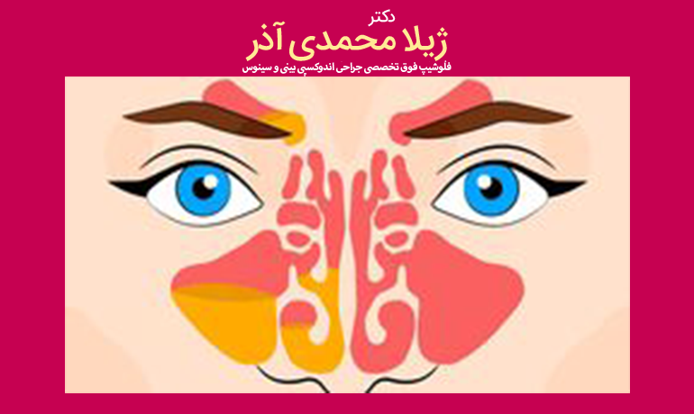 خارج کردن ایمپلنت از سینوس