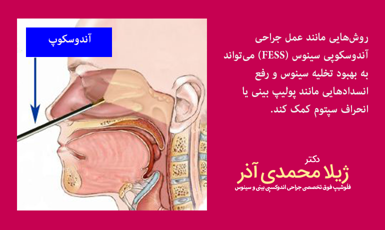 درمان سینوزیت مزمن با جراحی آندوسکوپی