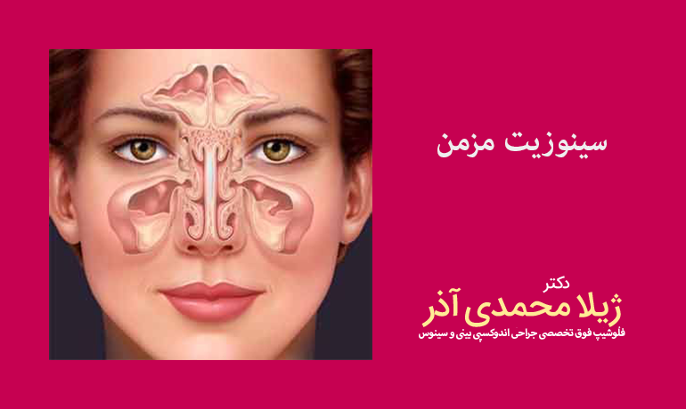 سنوزیت مزمن