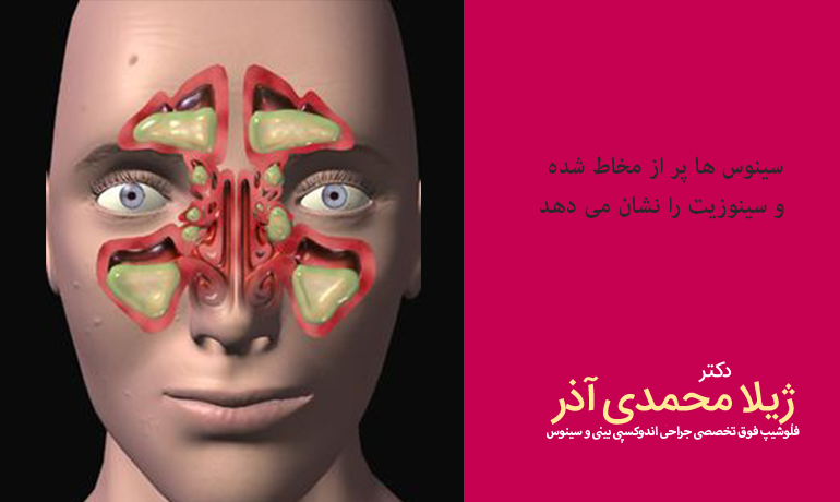 سنوزیت چیست؟