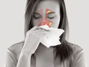 سینوزیت -دکتر ژیلا محمدی آذر