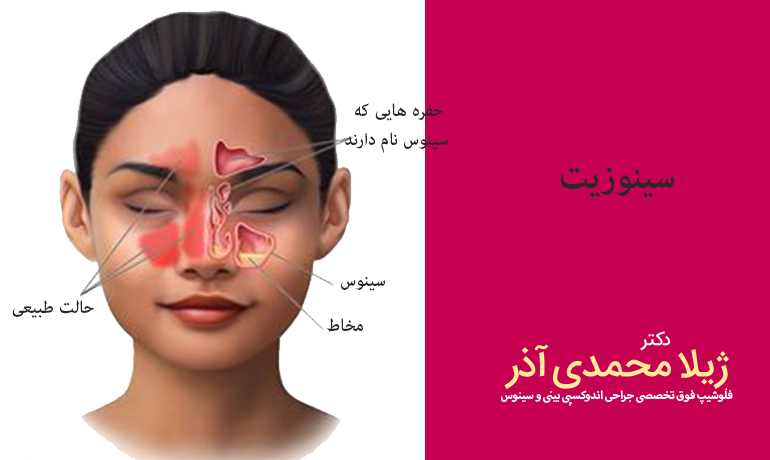 سینوزیت