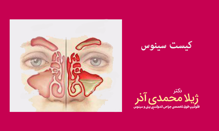 کیست سینوس ماگزیلاری