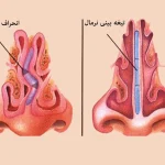 انحراف تیغه بینی - دکتر ژیلا محمدی آذر