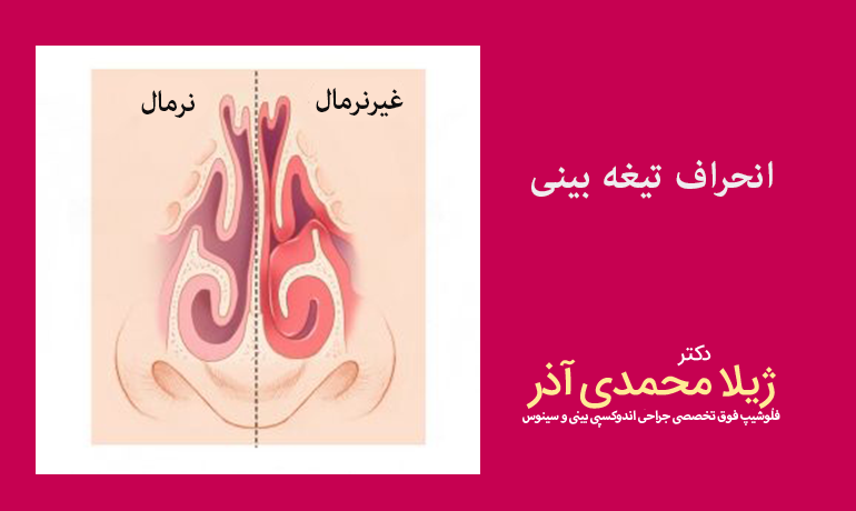 انحراف تیغه بینی