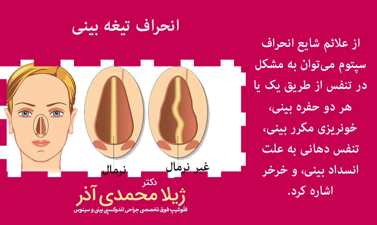 علائم انحراف تیغه بینی