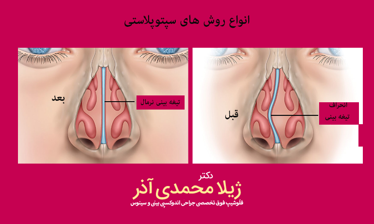 انواع روش های سپتوپلاستی