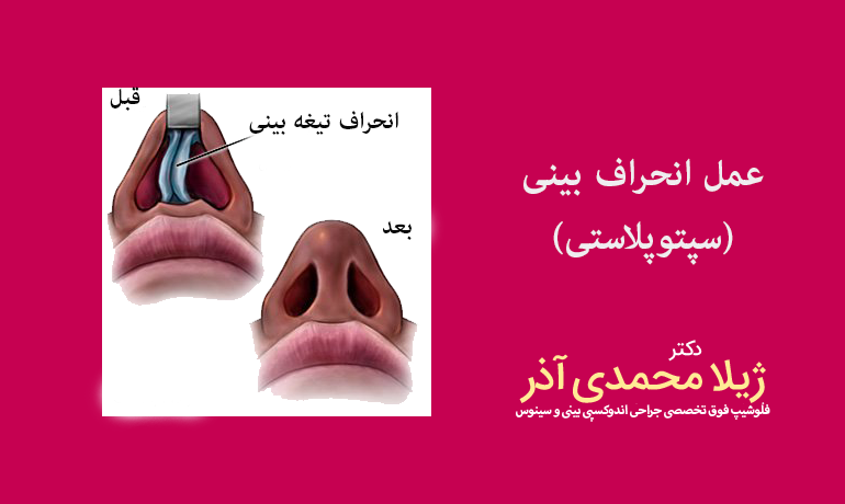 عمل انحراف بینی (سپتوپلاستی)
