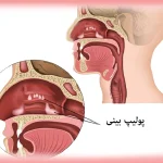 عمل پولیپ بینی