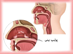 عمل پولیپ بینی