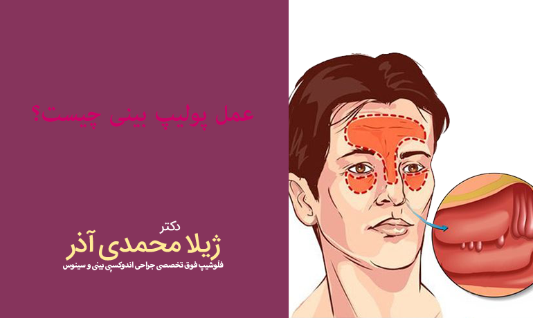  عمل پولیپ بینی چیست؟