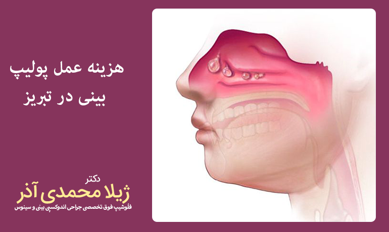 هزینه عمل پولیپ بینی