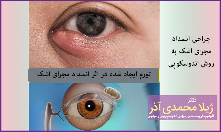 جراحی-انسداد-مجرای-اشک-به-روش-اندوسکوپی
