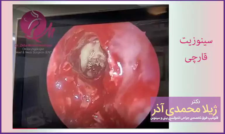 سینوزیت قارچی