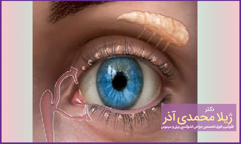 مراقبت-های-بعد-از-عمل-انسداد-مجرای-اشکی