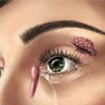 مراقبت-های-بعد-از-عمل-مجرای-اشکی