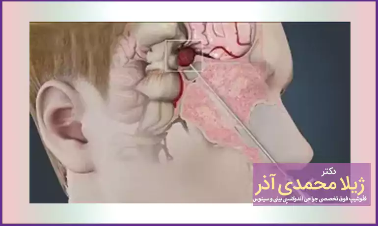 جراحی تومور مغزی با اندوسکوپی