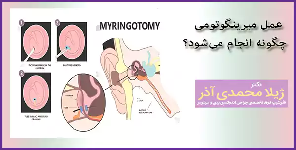 عمل میرینگوتومی چگونه انجام می‌شود؟