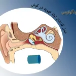 عمل گذاشتن لوله تهویه در گوش