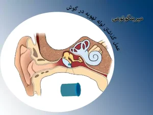 عمل گذاشتن لوله تهویه در گوش
