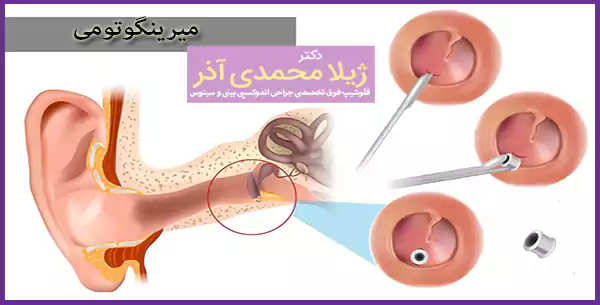 میرینگوتومی
