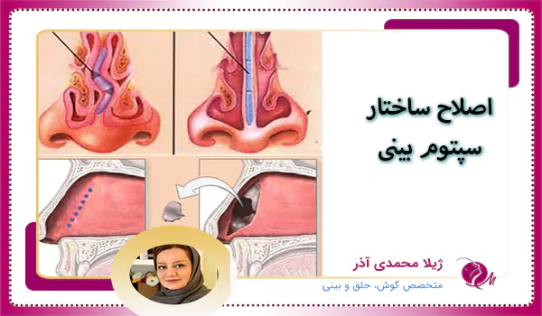 اصلاح ساختار سپتوم بینی در سپتورینوپلاستی