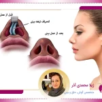 سپتورینوپلاستی در تبریز