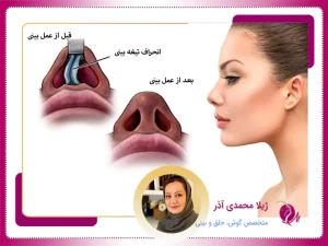 سپتورینوپلاستی در تبریز