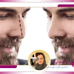 عمل بینی مردانه