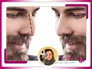 عمل بینی مردانه