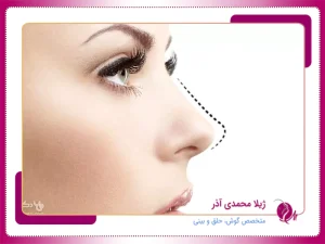 عمل بینی نیمه فانتزی