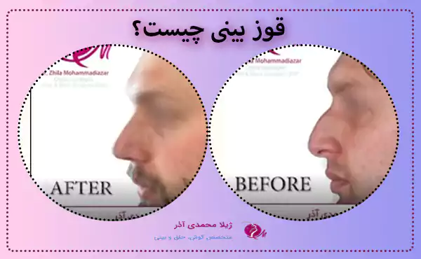 قوز بینی چیست؟