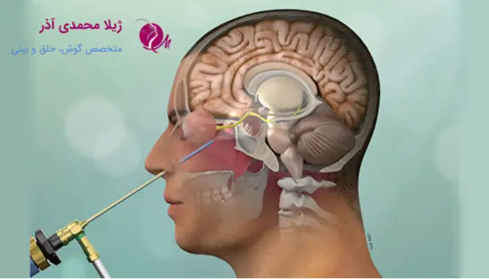 جراحی آندوسکوپیک هیپوفیز چیست؟