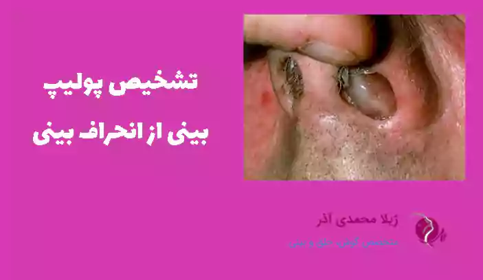 تشخیص پولیپ بینی از انحراف بینی