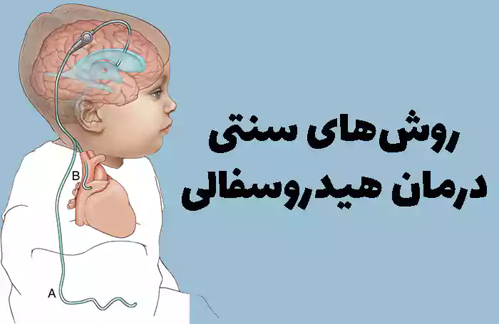 روش‌های سنتی درمان هیدروسفالی